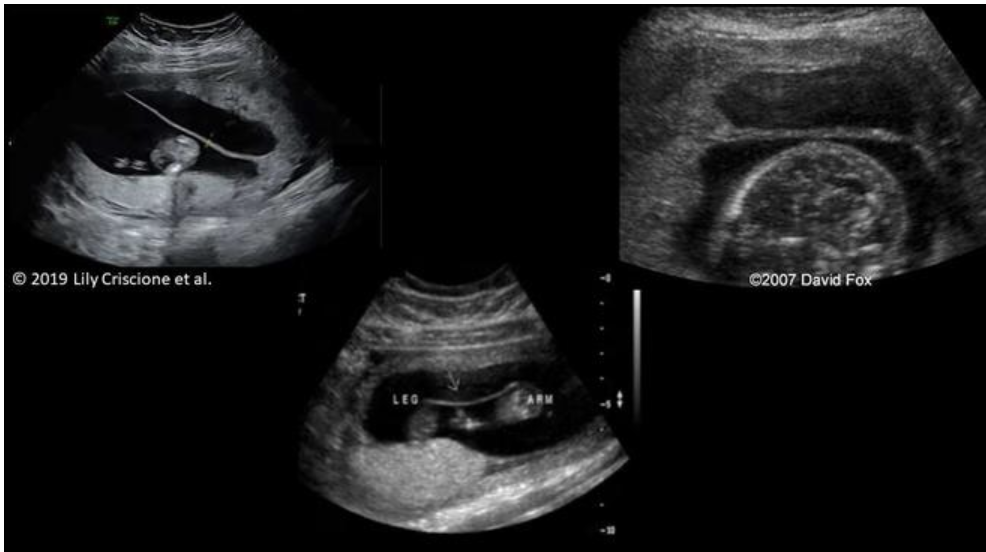 <p>which is uterine synechia</p><p>a) top left</p><p>b) top right</p><p>c) bottom middle</p>