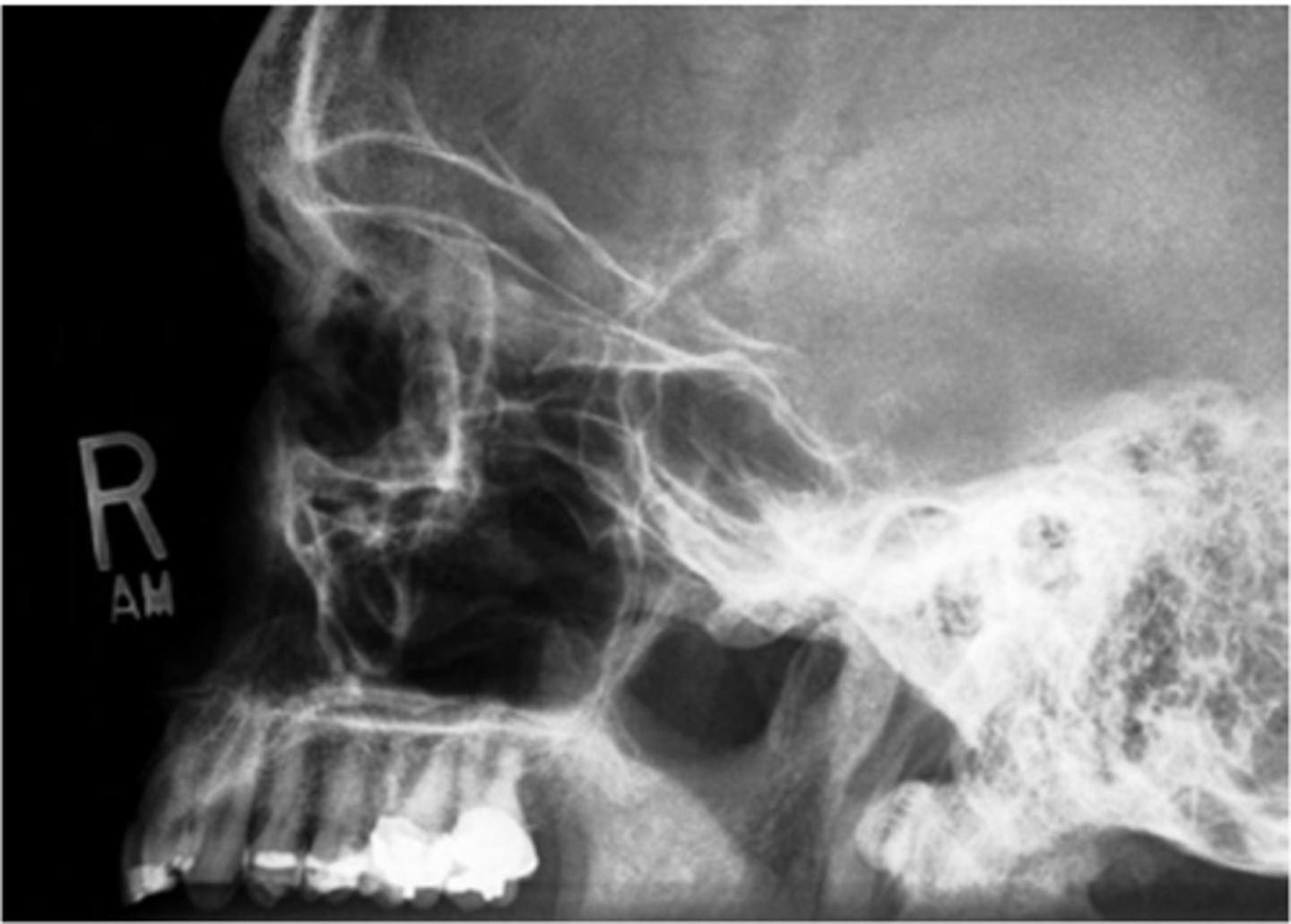 <p>Repeatable errors (three)—</p><p>Criterion 1: Anatomy demonstrated: Aspects of the ethmoid and maxillary sinuses are not well demonstrated because of rotation of the skull. </p><p>Criterion 2: Positioning: Tilt of the skull is evidenced by lack of superimposition of orbital plates of the frontal bone. Note: Rotation of skull is evidenced by lack of superimposition of greater wings of sphenoid bones. CR centering is slightly anterior. </p><p>Criterion 5: Anatomic side markers: No anatomic side marker is visible.</p>