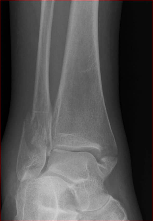 <p>occurs at ankle- affects both tibia and fibula</p>