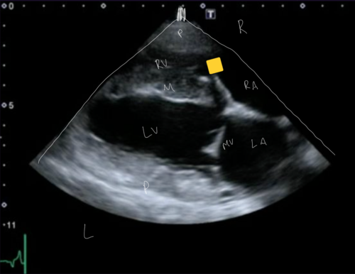 <p>Right Parasternal Long axis View</p>