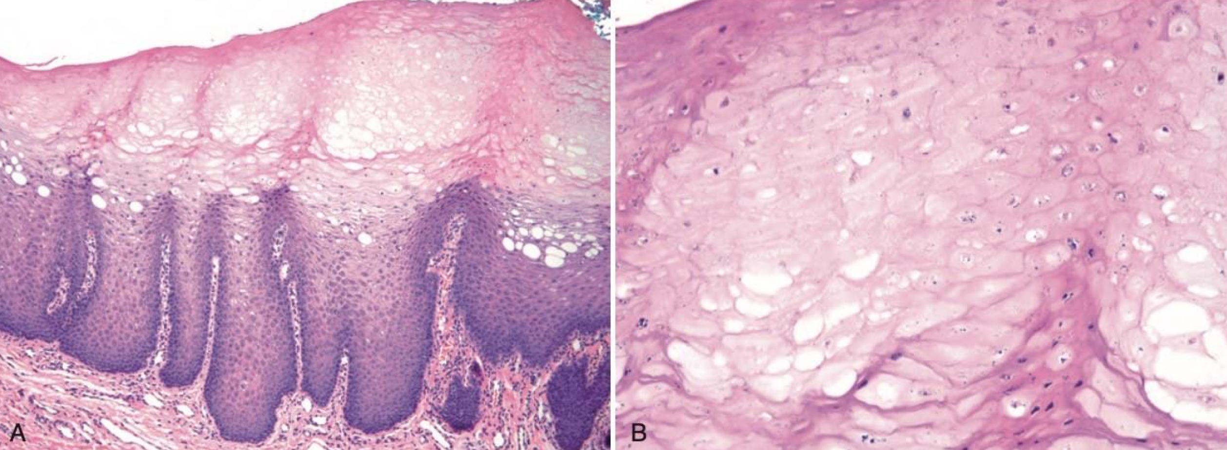 <p>which environmental/reactive lesion: pale almost necrotic and edematous </p>