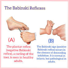 <p>reflex from newborn that disappears as CNS matures</p><p>positive response is normal in infants → great toe pointing upward and the other toes fanning out when the sole of the foot is stimulating, usually disappears between 12-24 months</p><p>negative respone (or normal response) → downward curling of toes</p>
