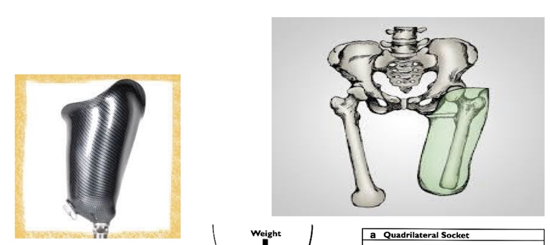 <p>-ischium is contained within socket…gives control d/t contact</p><p>-can place a flexible brim for comfort…”comfort flex socket”</p>