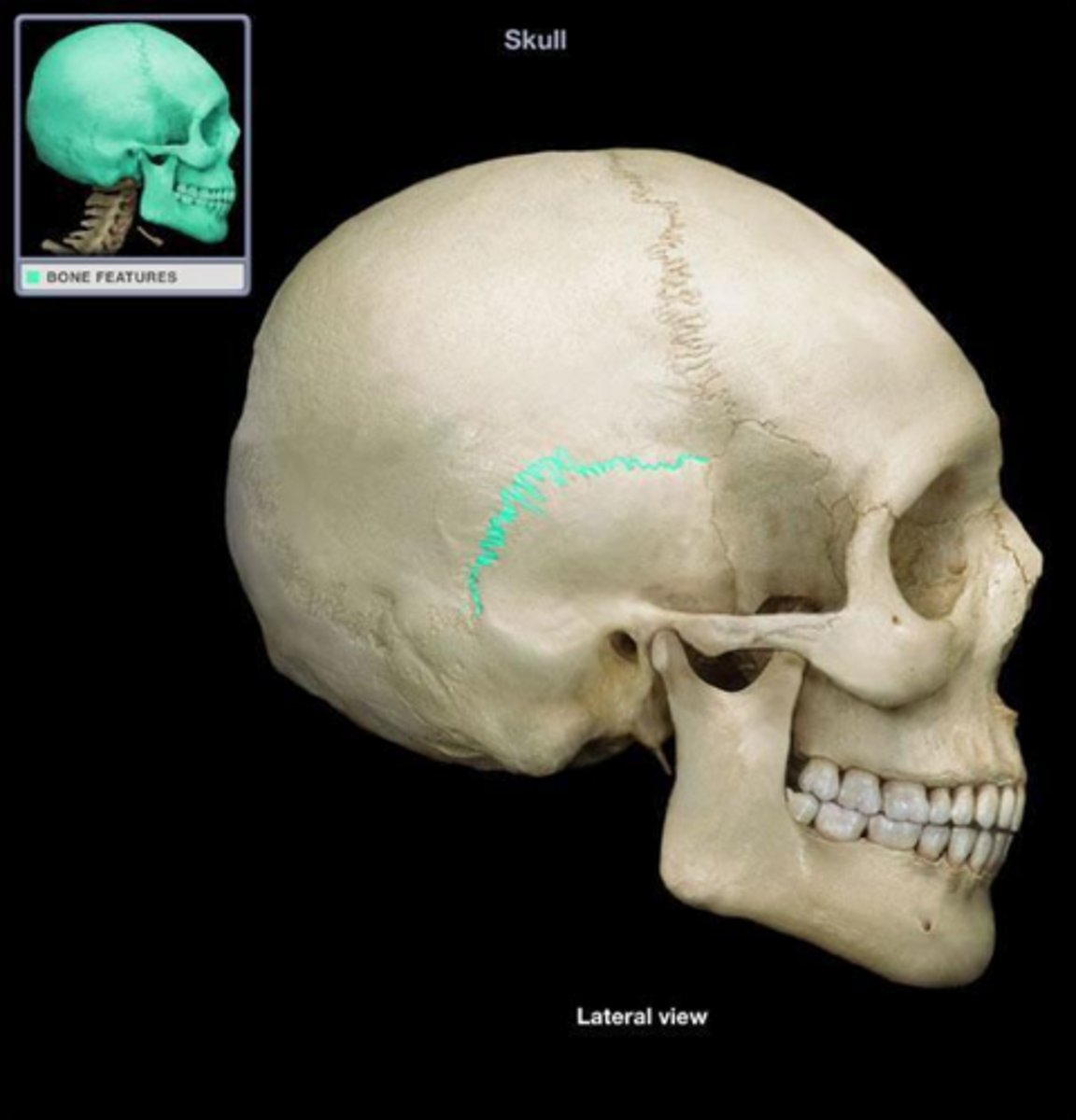 <p>The internal acoustic meatus transmits the facial nerve (CN VII) and vestibulocochlear nerve (CN VIII).</p>