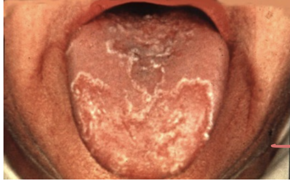 <p>Under keratinized of filiform papillae </p>