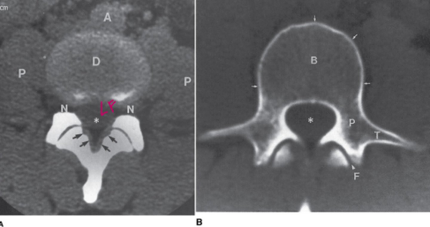 <p>A=aorta</p><p>D=intervertebral disk</p><p>N=neural foramen</p><p>P=psoas muscles</p><p>arrows=ligamentum flavum</p><p>Asterisk on A=thecal sac</p><p>Asterisk on B=spinal canal</p><p>P=pedicle</p><p>B=Vertebral body</p><p>T=transverse process</p><p>F=facet joint</p>