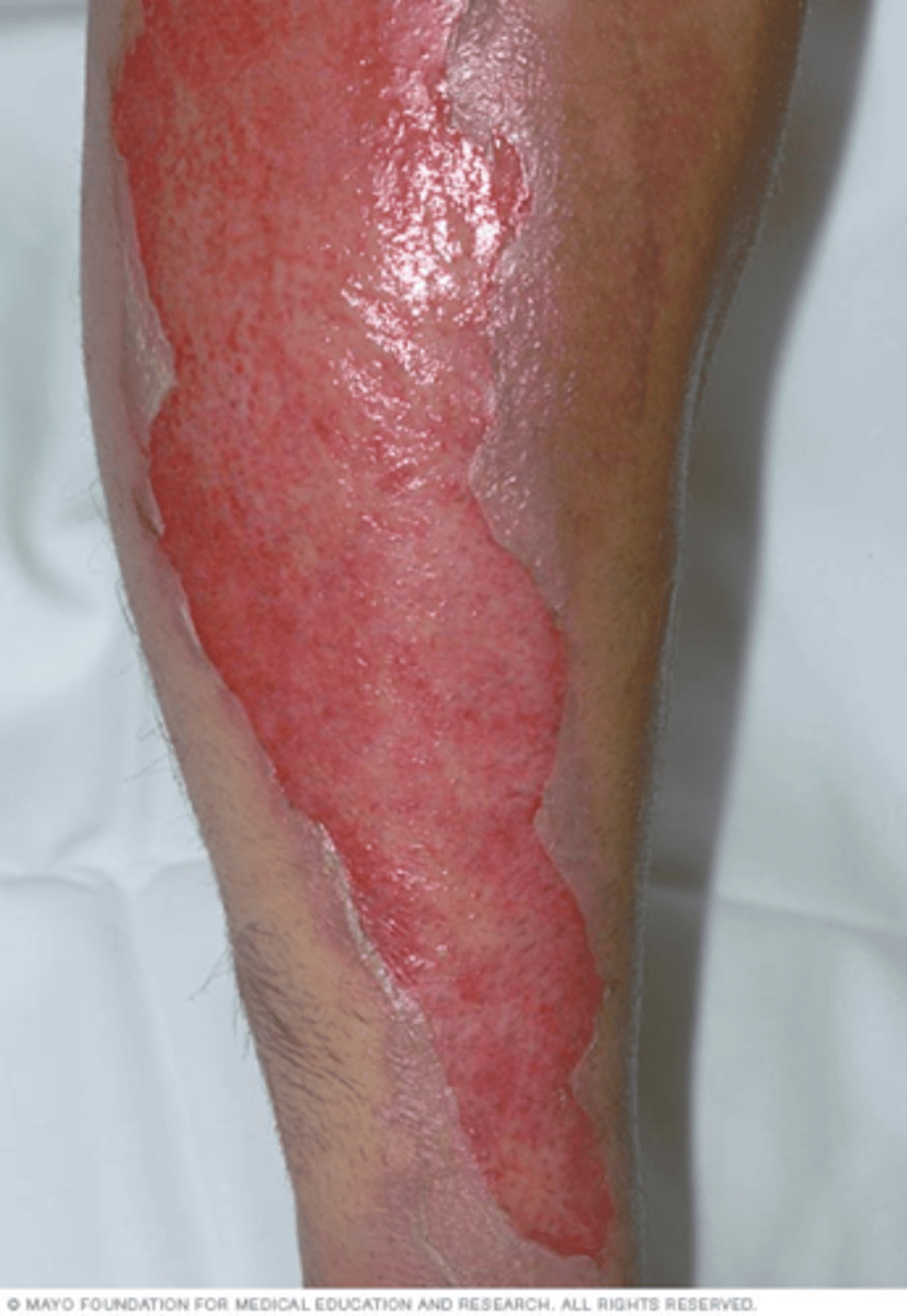 <p>Extends through entire epidermis and part of the dermis; Redness, pain, and blistering</p>