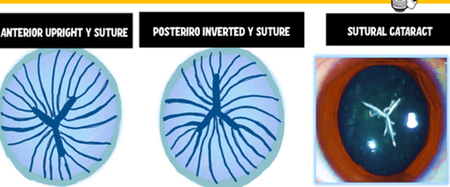 <p>Upright Y anteriorly</p><p>Inverted Y posteriorly</p>