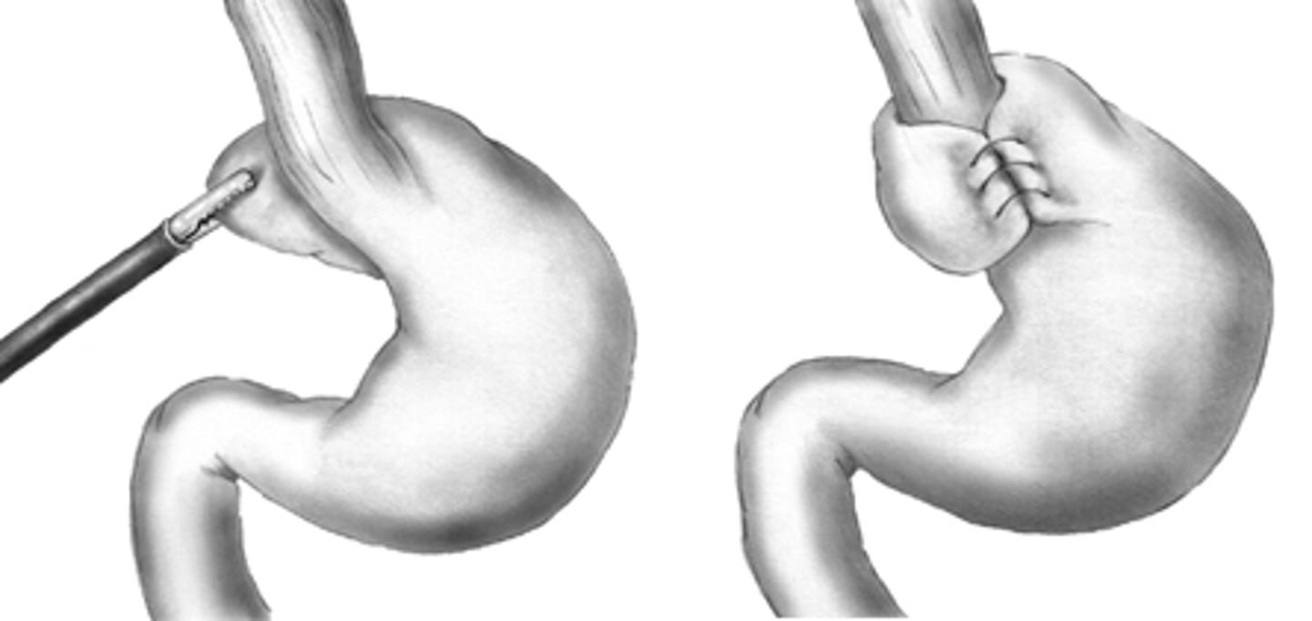 <p>- Nissen fundoplication (wrap fundus around sphincter)</p><p>- GT tube placement</p>