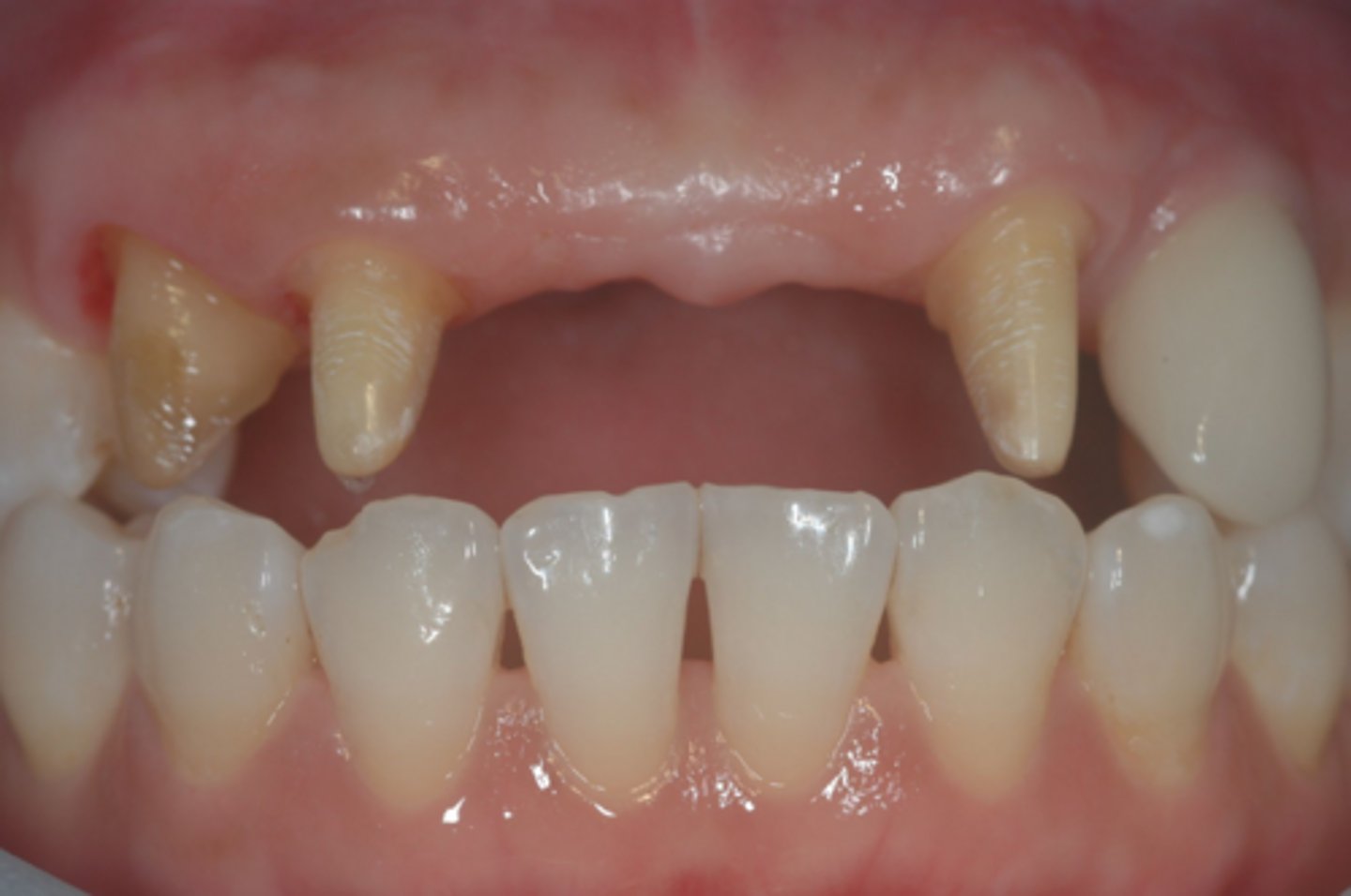 <p>Which of the four factors determining criteria for success of a provisional crown are you most concerned for here?</p>