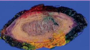 <ul><li><p><strong>Sharp dissection</strong> → scalpel blade is best</p><ul><li><p>Gentle tissue handling</p></li><li><p><strong>Hemostasis</strong></p><ul><li><p>Prevent release of tumor emboli  → ligate vein 1st</p></li></ul></li></ul></li><li><p><strong>Minimal handling of tumor itself </strong></p><ul><li><p>Use appropriate suture → monofilament (PDS)</p></li></ul></li><li><p><strong>Lavage</strong>, Avoid drain</p></li><li><p><strong>Change instruments, gloves, drapes for closure </strong></p><ul><li><p>limit contamination / seeding</p></li></ul></li><li><p><span style="color: red;"><strong><u>Post removal biopsy!!!</u></strong></span></p><ul><li><p>Allows for margin assessment</p></li><li><p>Dictates adjunctive treatment plan</p><ul><li><p>radiation, chemo, 2nd sx</p></li></ul></li></ul></li></ul><p></p>