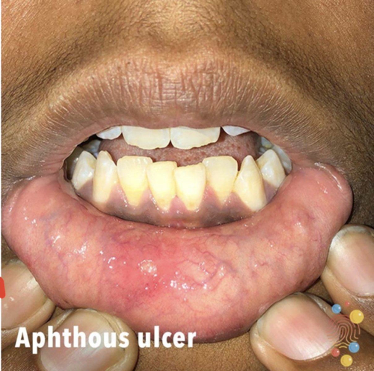 <p>Aphthous ulcer</p>