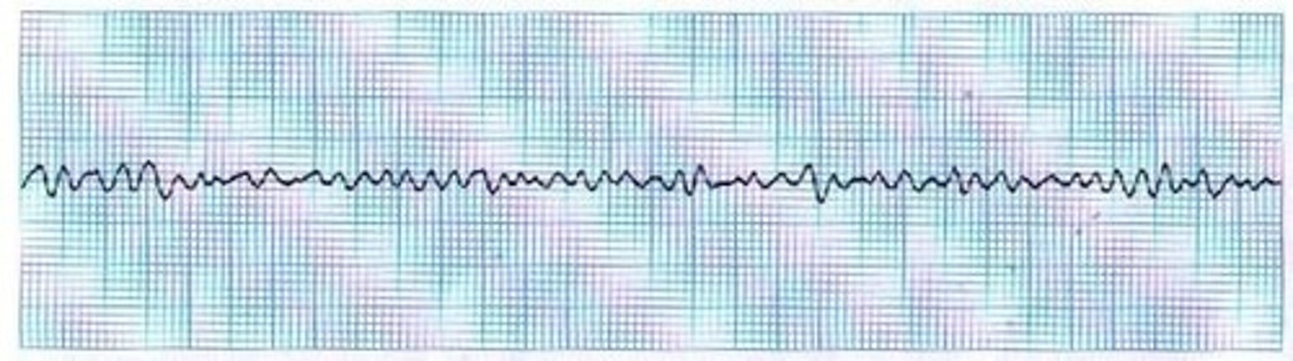 <p>the rapid, irregular, and useless contractions of the ventricles</p>