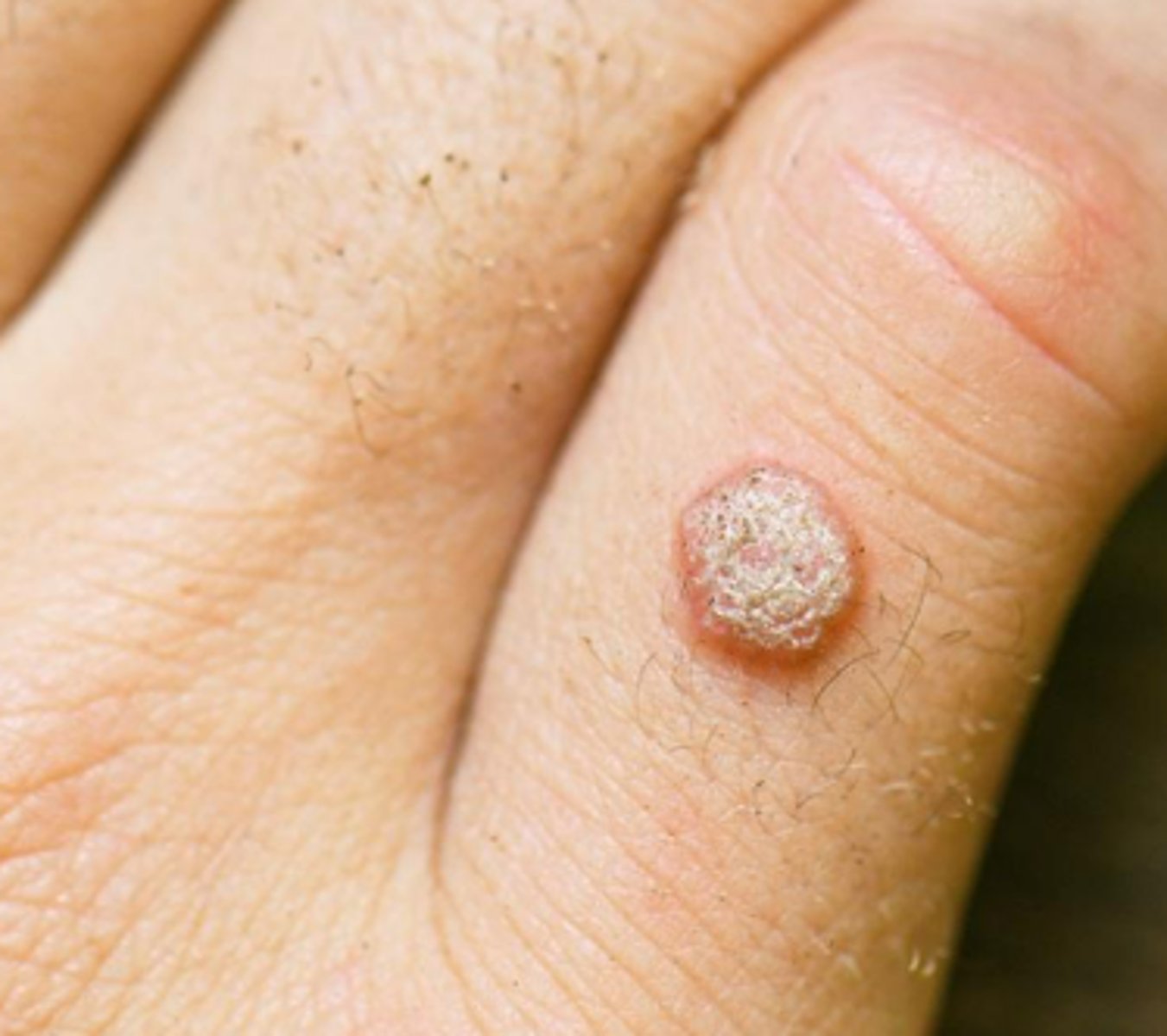 <p>•A solid, elevated, palpable lesion measuring &lt; 1 cm</p><p>- Ex: Elevated nevus, wart, insect bite, acne</p>