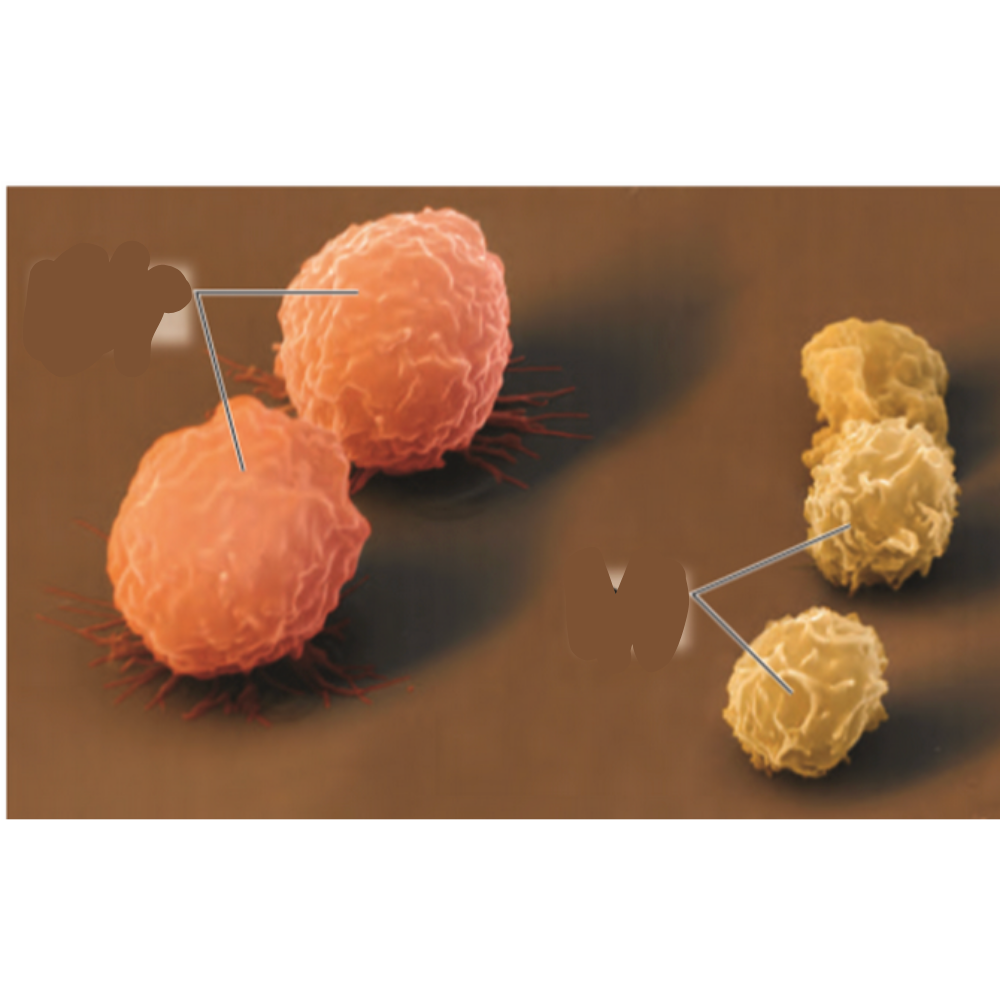 <p>Which is the cancerous cell?</p>