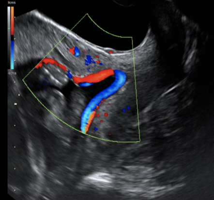 <p>which types of placenta previa is defined as placental <strong>vessels crossing</strong> the<strong> internal os</strong></p><p>a) velamentous previa</p><p>b) vasa previa</p><p>c) partial previa</p><p>d) marginal previa</p>