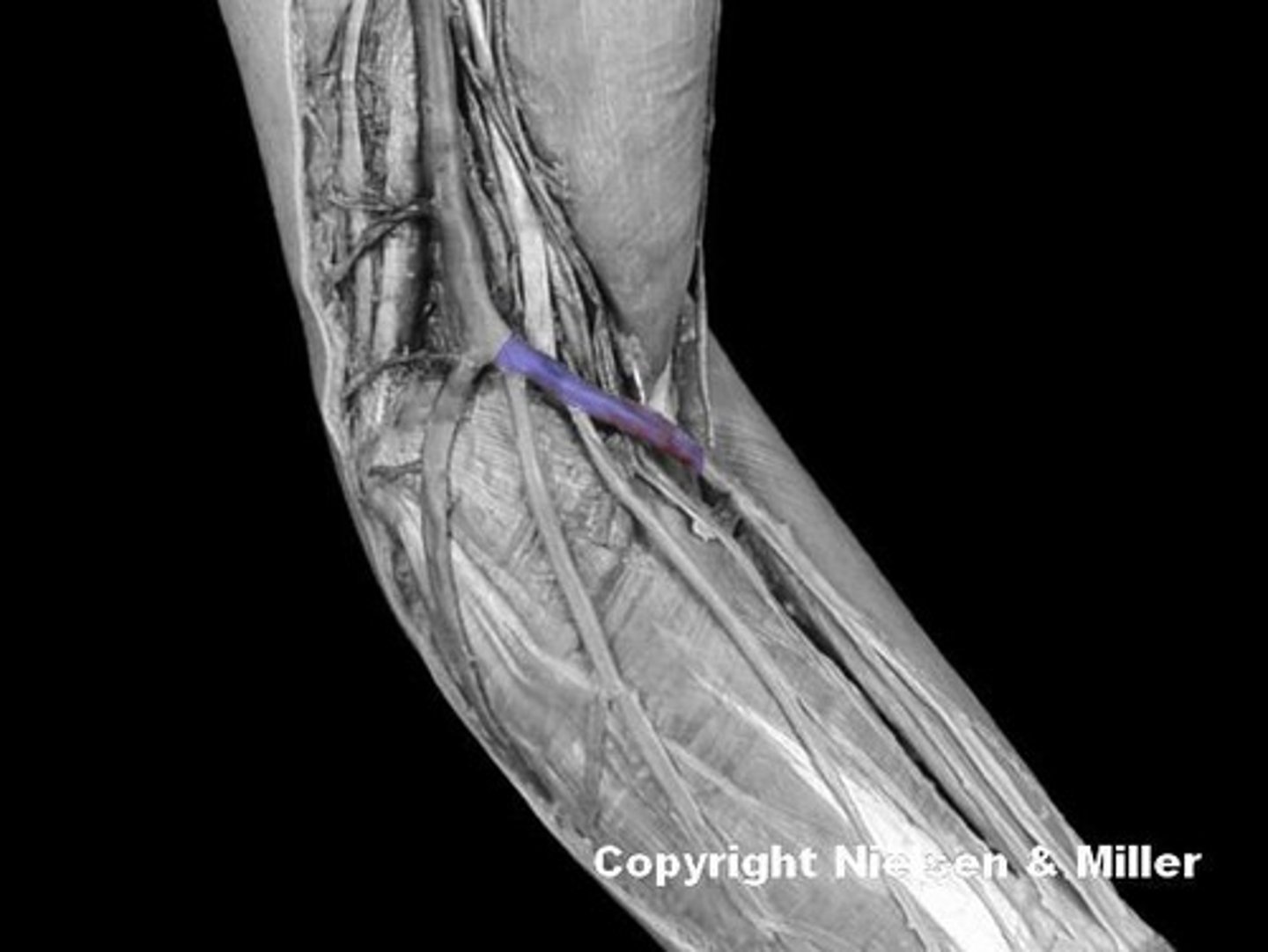 <p>Identify the highlighted vessel, which is the preferred site for removal of a blood sample (anteromedial view of superficial veins of arm/forearm)</p>