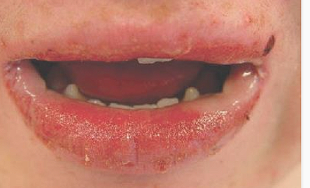 <p><span>erythema, erosions, or bullae</span></p>