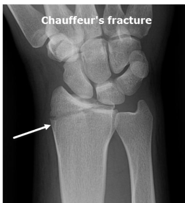 <ul><li><p>Special</p></li><li><p>Fx of radial styloid process (blow to lateral side of distal forearm)</p></li></ul><p></p>