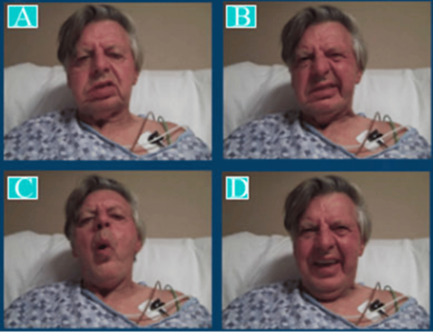 <p>Observe: Right face (lower)</p><p>o Right face droop and flat nasolabial fold at rest (A)</p><p>o Reduced right face retraction on volitional lip retraction (B)</p><p>o Reduced volitional lip rounding on right (C)</p><p>o Relatively symmetric emotional smile (D)</p>