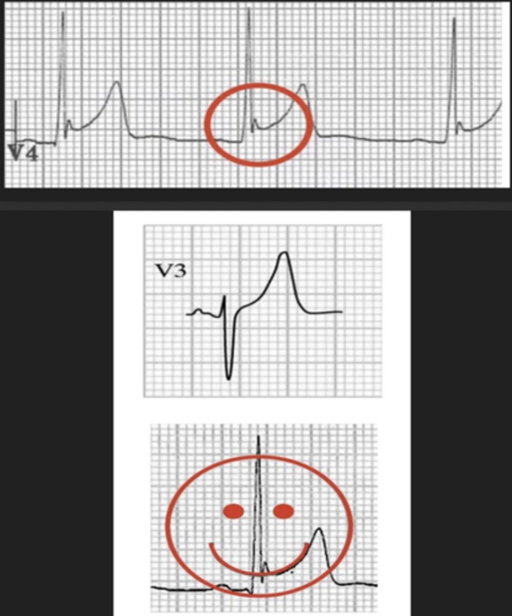 <p>- widespread concave ST elevation</p><p>- notching or slurring a J point "fishhook"</p><p>- tall asymmetric T waves</p><p>- no reciprocal ST depression</p><p>- ST changes remain constant (STEMIs evolve)</p>