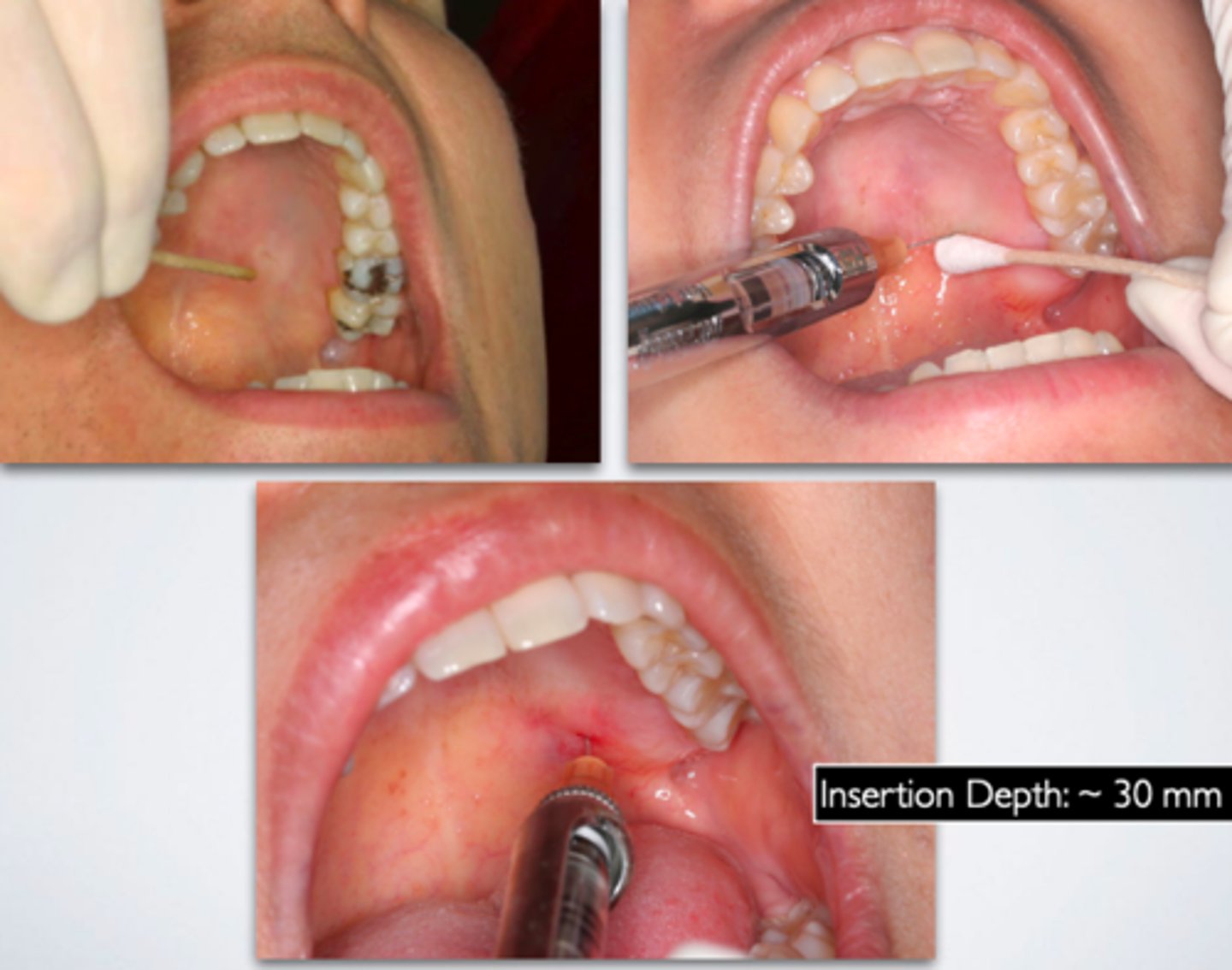 <p>ID the anesthesia technique:</p>