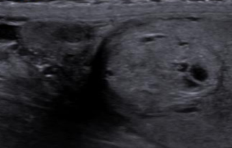 <p>sono appearance of metastasis</p>