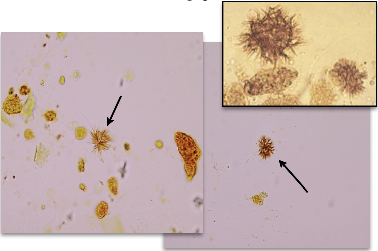 <ul><li><p class=""><strong>Appearance</strong>: Yellow-brown (sometimes bright orange) needles or granules, often in clumps or attached to cells</p></li><li><p class=""><strong>Urine pH</strong>: Acidic</p></li><li><p class=""><strong>Solubility</strong>: Acetic acid, HCl, NaOH, acetone</p></li><li><p class=""><strong>Bilirubin test</strong>: Positive, won’t see this otherwise</p></li><li><p class=""><strong>Clinical context</strong>: Seen in severe liver disorders; correlate with patient history and jaundice</p></li><li><p class=""><strong>Additional notes</strong>: Can be mistaken for amorphous material; distinct spiky needle bundles</p><p></p></li></ul><p></p>