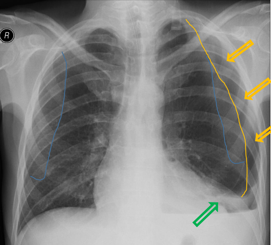 <p>Patient history: blunt chest trauma in a young patient </p><p>Modality: PA chest radiograph </p><p>Region: chest, pleura</p><p>Radiologic sign: Left peripheral space is radiolucent without lung markings (yellow arrow); visible visceral pleural line (yellow line); slight mediastinal shift to the right. Left diaphragm and lateral sinus cannot be differentiated due to pleural fluid (horizontal fluid level is visible), while little above left lung basis partially collapsed (green arrow). Scapula lines are signed with blue lines. </p><p>Diagnosis: left-sided hydropneumothorax</p>