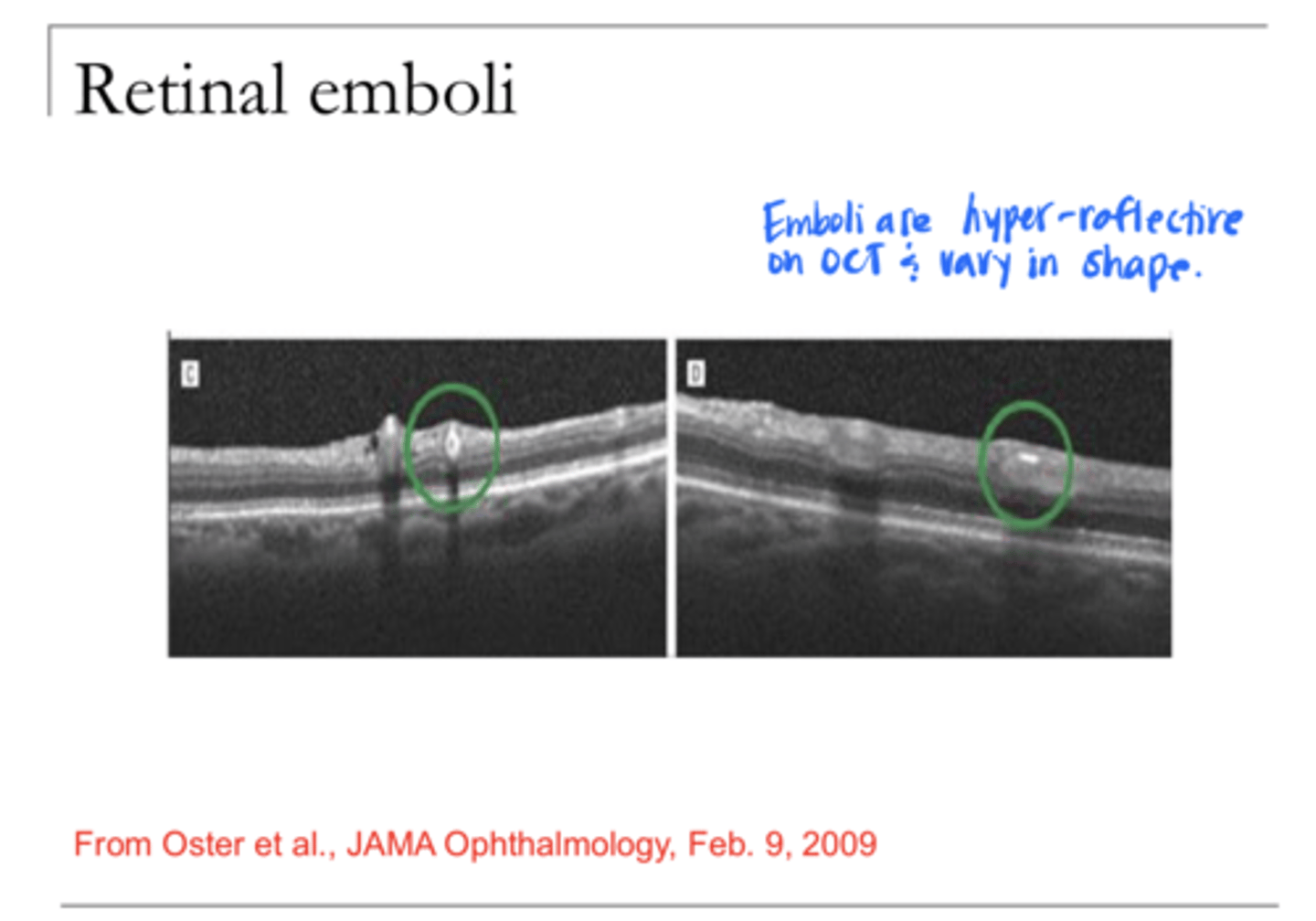 <p>Retinal Emboli on OCT (Pic)</p>