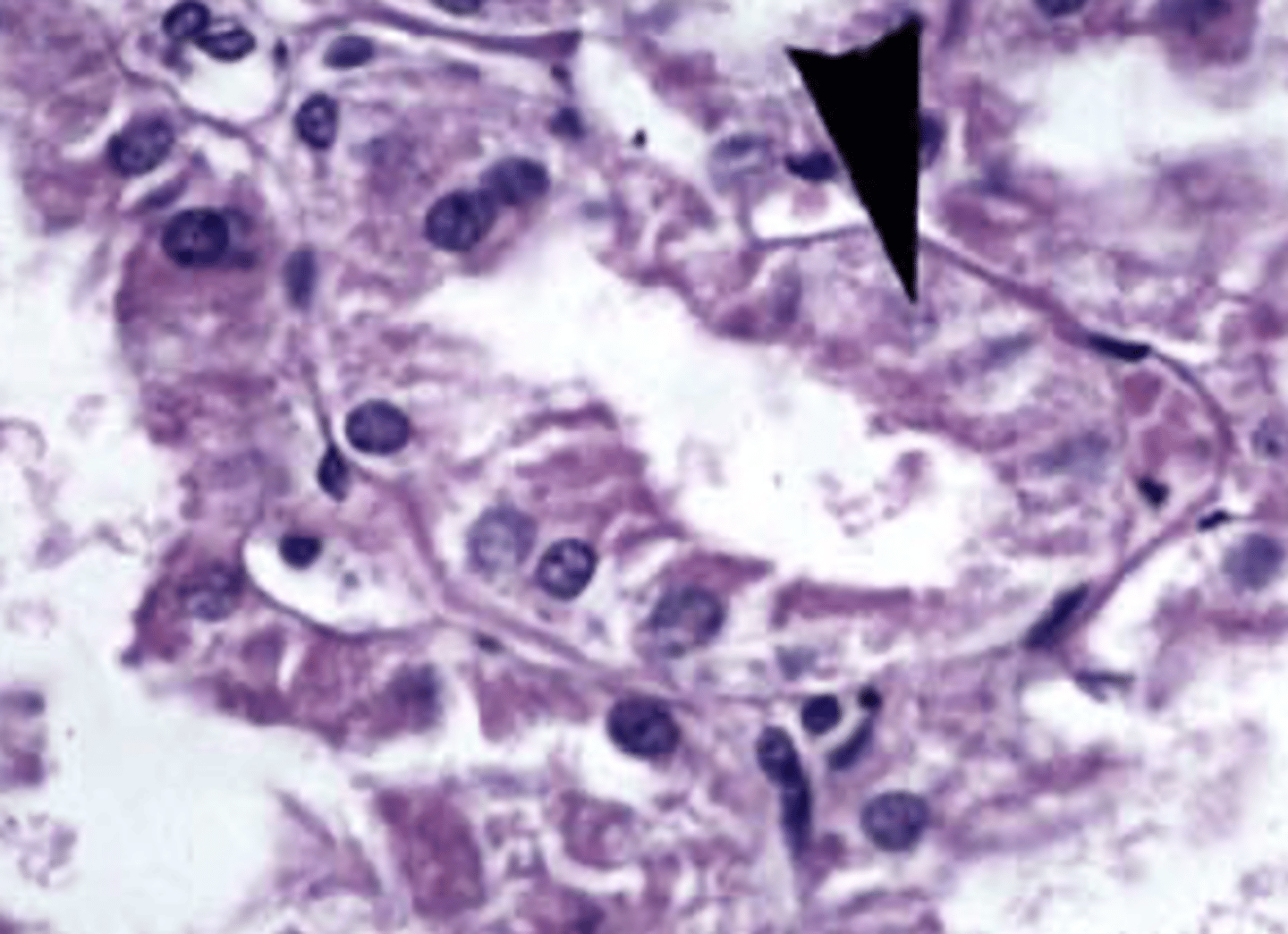 <p>This is an image showing a cell undergoing necrosis. What type of nuclear changes are occuring?</p>