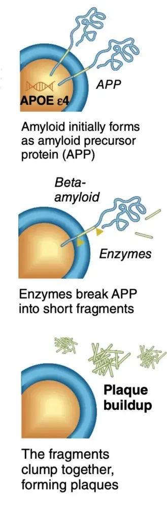 <p>APOE4 and Alzheimer’s</p>