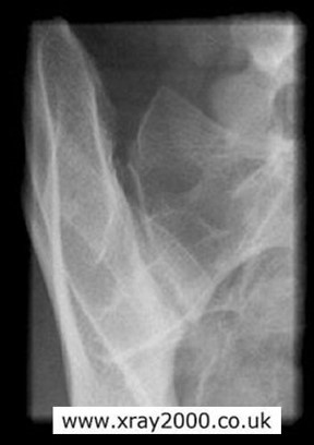 <p>Excess obliquity.</p>
