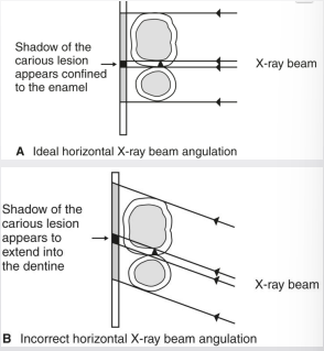 <ul><li><p>contact overlap can obscure lesion and DEJ </p></li><li><p>changes of lesions relative to other structures→ DEJ and pulp</p></li></ul><p></p>