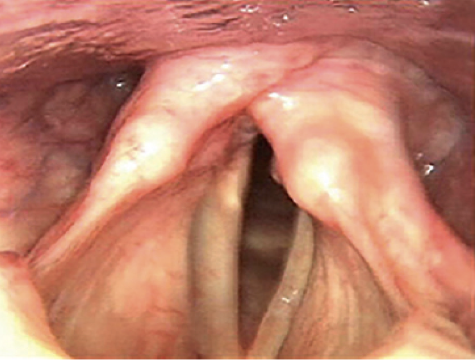 <p>abnormal stiffening and immobility of the cricoarytenoid jount, that can causes fixed addiction, fixed abduction, dyspnea &amp; odynophagia</p><p>typically caused by:</p><ol><li><p>arthritis/joint disease</p></li><li><p>intubation</p></li></ol>