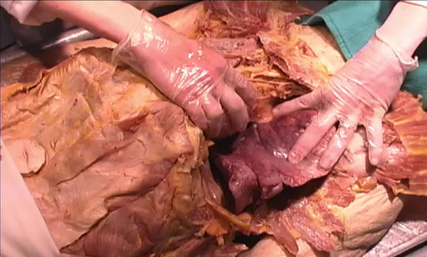 <p>In what direction is the heart being pulled?</p><p>dorsal</p><p>anterior</p><p>medial</p><p>posterior</p>