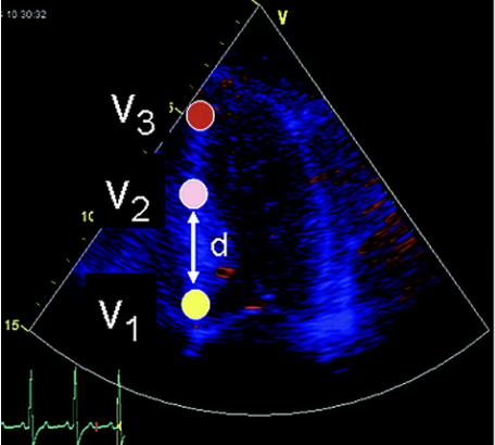 <p>based on difference in TDI velocity between sample volumes divided by distance between them&nbsp;</p>