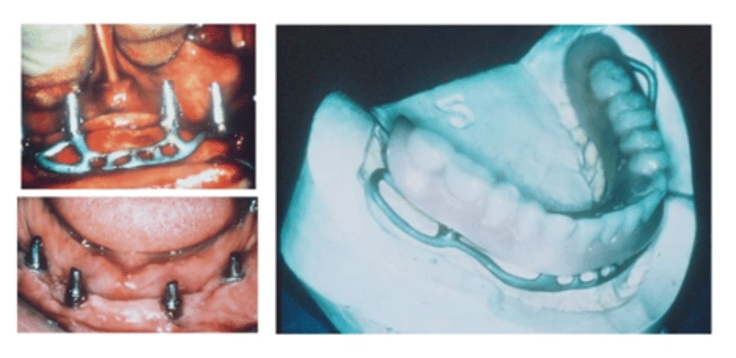 <p>- Metal implant framework rests directly on top of the bone, underlying the periosteum</p><p>- Provides attachment posts which extend through the gingival tissue for prosthesis anchorage</p>