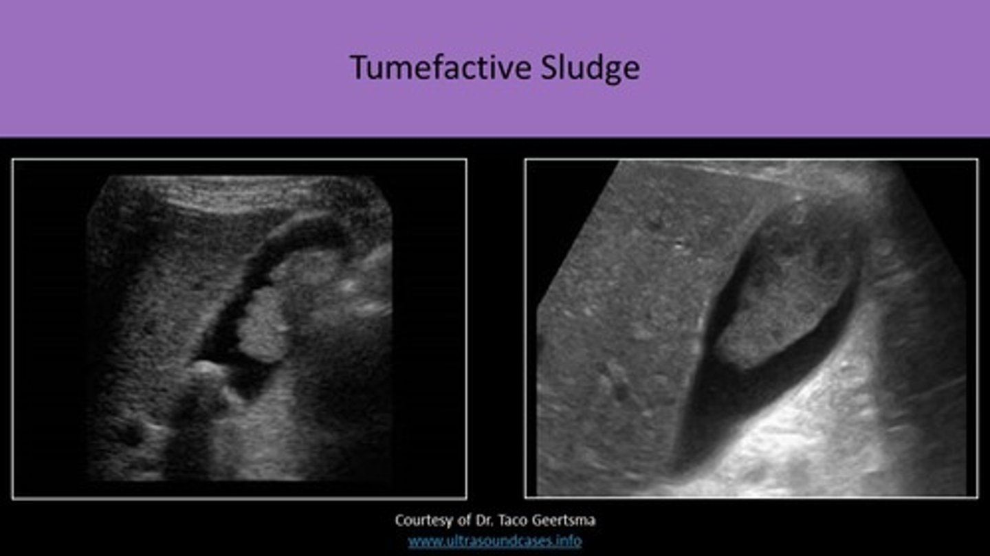 <p>sludge that mimics polypoid tumors/GB mass</p>