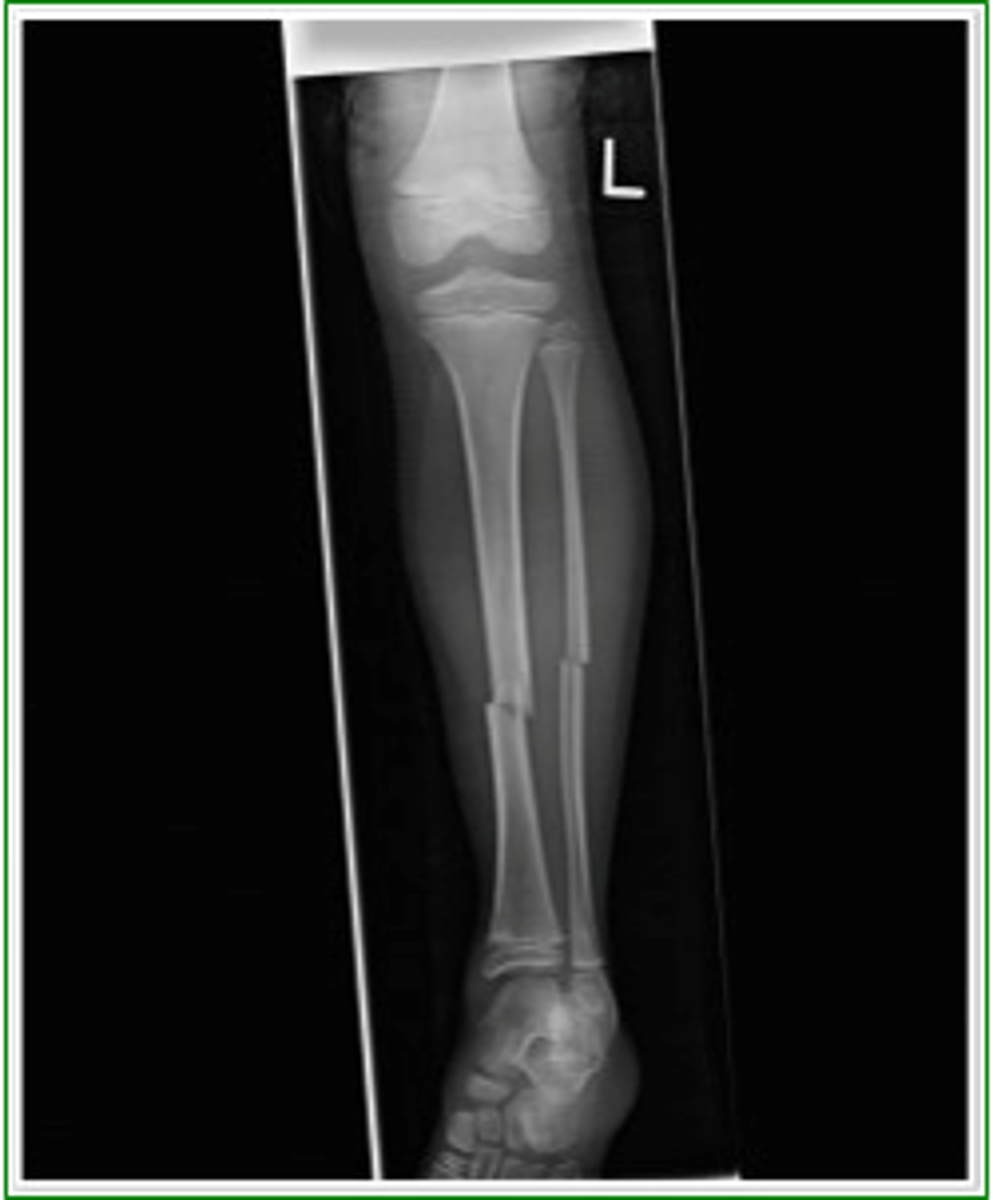 <p>form of high boot top fracture</p><p>- fracture will typically occur at the point where top of shoe/boot ends</p><p>- fracture pattern seen in sports like hockey and skiing</p>