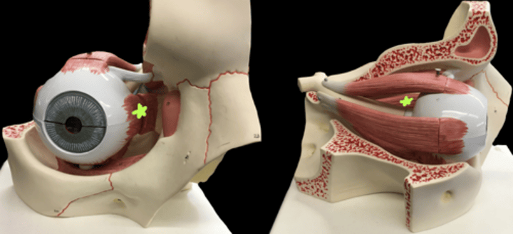 <p>medial side eye muscle</p>