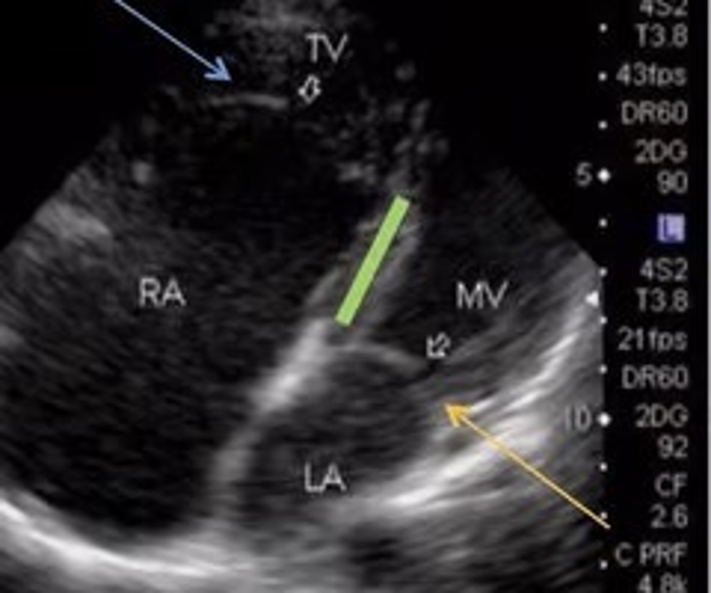 <p>Best seen in 4 Chamber</p><p>Apical displacement of tricuspid valve -> TV is lower than it should be</p>
