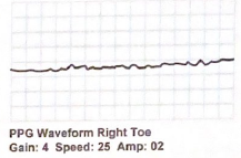 <p>What term describes this digital PPG (photoplethysmography)  waveform:</p>