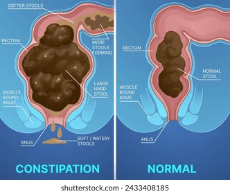 <p>Hardened stool lodged in the rectum that cannot be expelled</p>
