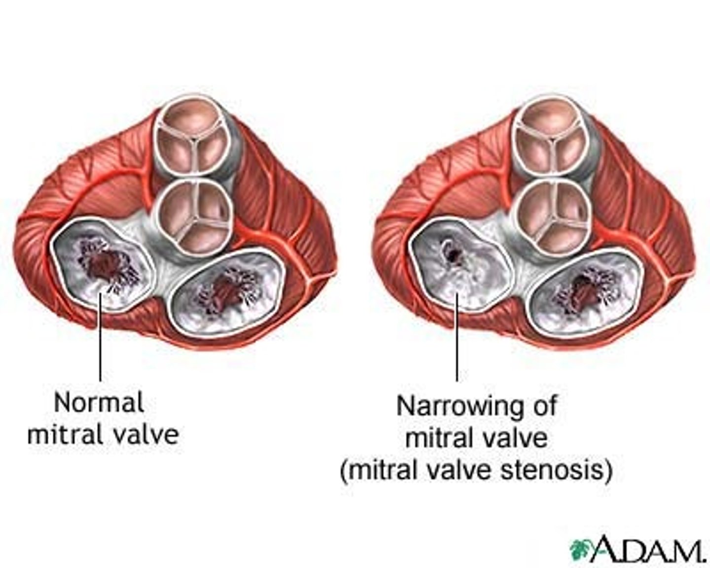 <p>impaired flow from left atrium to left ventricle</p>