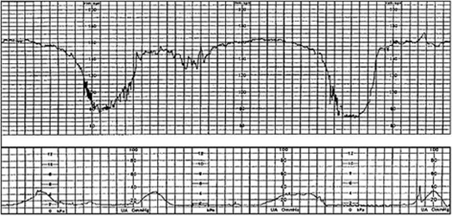 <p>- occur at any point with or without a contraction</p><p>- r/t cord compression</p>