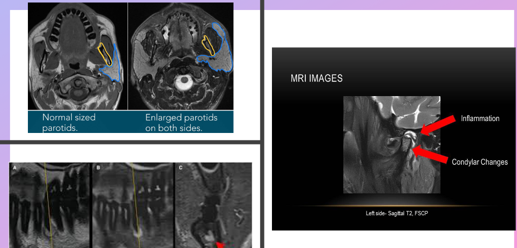 <p>Patient with jaw pain when chewing, jaw locks, no visible swelling, and no significant findings on PANO</p><ul><li><p>MRI can reveal disc replacement and/or joint inflammation that is not visible on a PANO</p></li></ul><p>Patient with recurrent swelling on left cheek, no pain but discomfort, reduced salivary flow from parotid, negative PA and PANO findings</p><ul><li><p>MR sialography to view ductal system of gland</p></li></ul><p>Trauma to central incisor, gray color, no mobility, asymptomatic, no fracture on CBCT</p><ul><li><p>MRI of the pulp chamber can detect changes in blood flow or inflammation in pulp </p></li></ul><p></p>