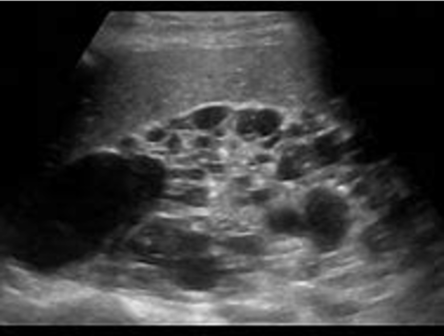<p>- diffusely enlarged kidneys</p><p>- multiple cysts of varying size</p><p>- loss of shape</p>