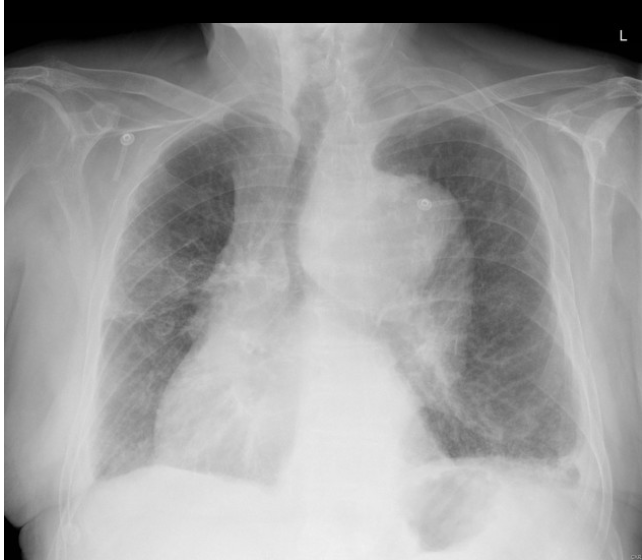 <p>CXR findings of a Aortic Dissection</p>