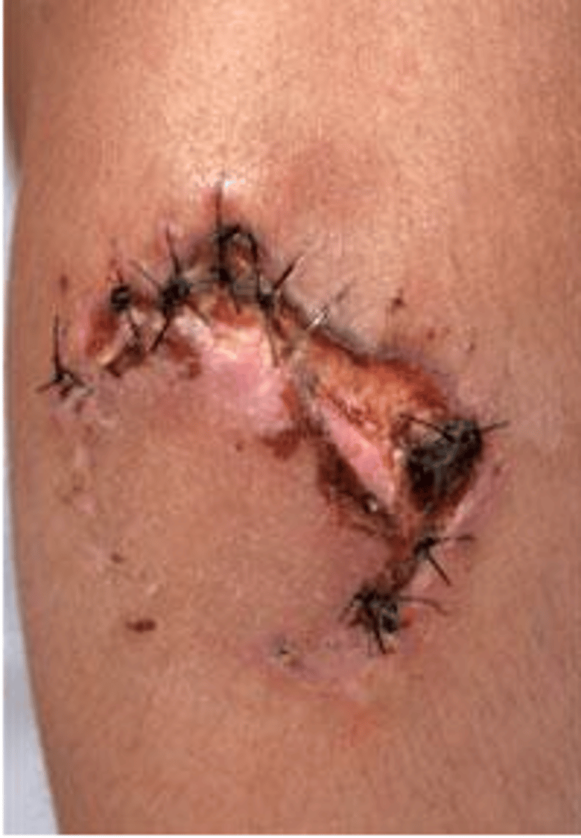 <p>An open injury caused by a hard impact to soft body tissue.</p>
